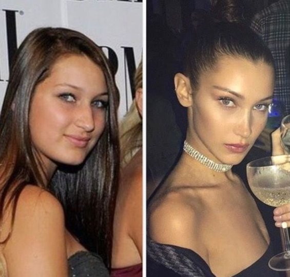 Bella Hadid spoke about the nose surgery you did at the age of 14 and the comparisons with Gigi