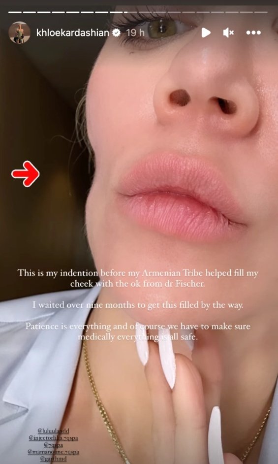 Khloe Kardashian Shows Off Scars From Skin Cancer Removal