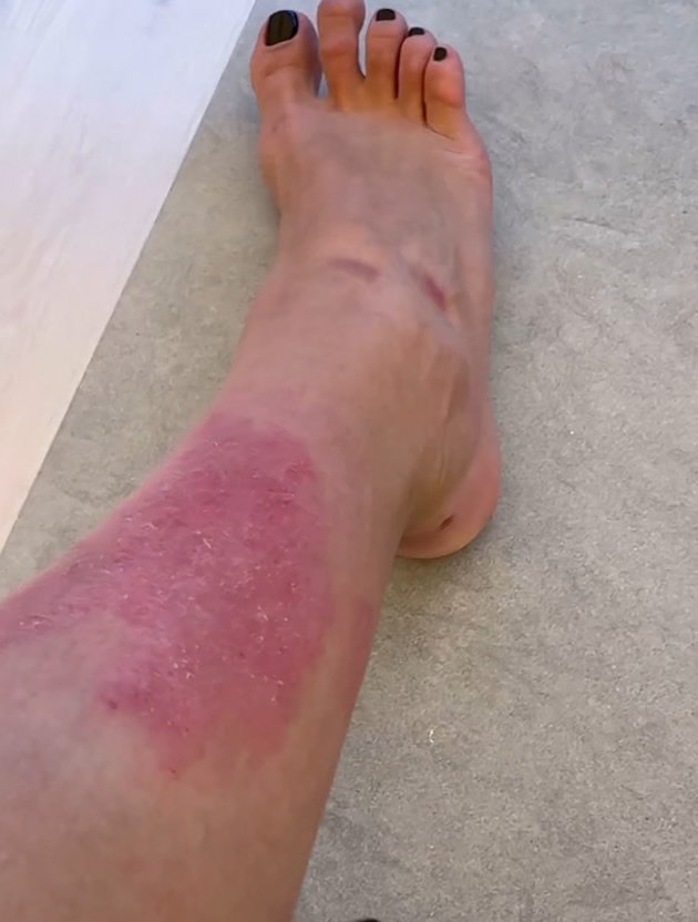 Kim Kardashian Shows Inflamed Leg Skin From Psoriasis