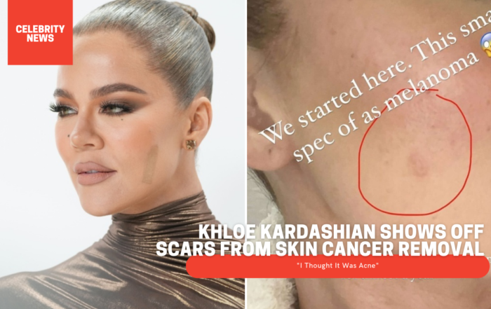 Khloe Kardashian Shows Off Scars From Skin Cancer Removal