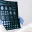 New Alzheimer's Treatment Demonstrates Significant Cognitive Improvement in Landmark Phase 3 Trial
